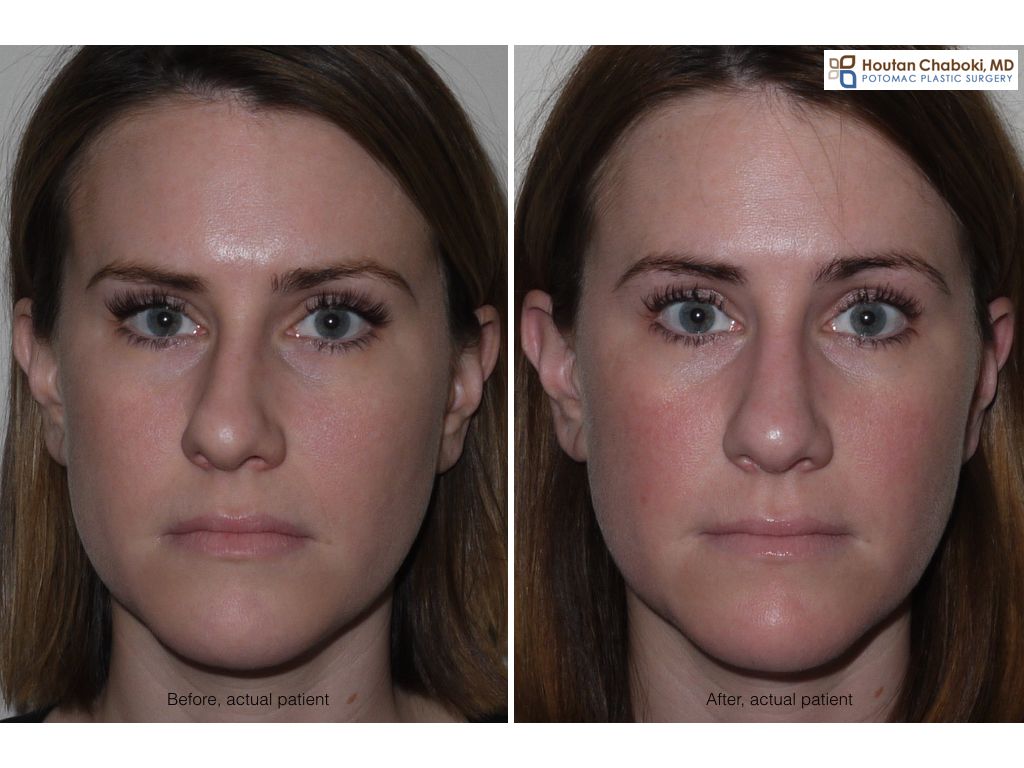 Blog post before after septoplasty deviated septum closed rhinoplasty001