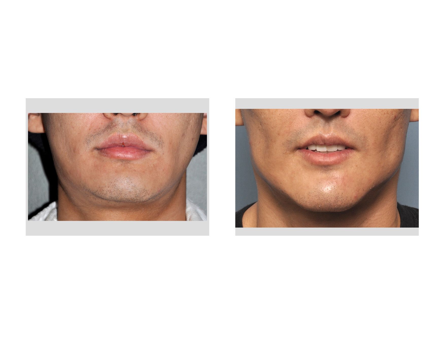 Custom Jawline Implant result frofnt view Dr Barry Eppley Indianapolis