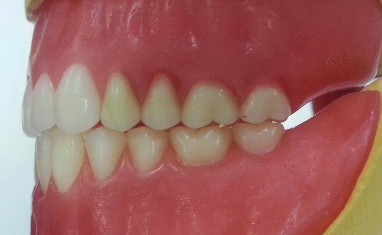 Posterior Occlusion