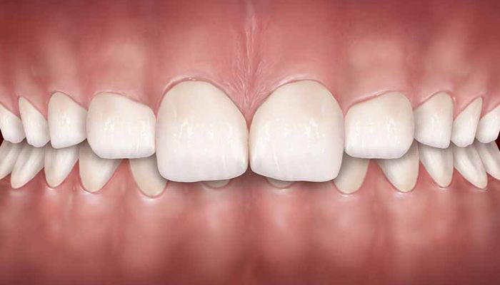 Overbite linked to snoring