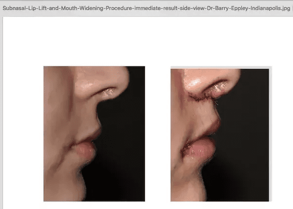 Lips Extend How to widen lips? | Looksmax.org - Men's Self-Improvement & Aesthetics