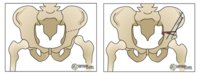 Salter Osteo 600px.jpg