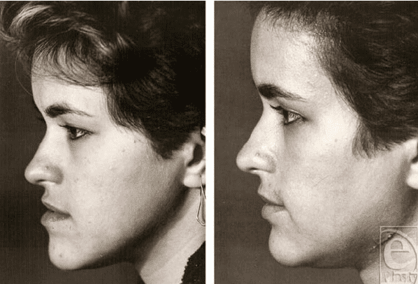 A typical patient with mandibular prognathism left preopera tive profile right