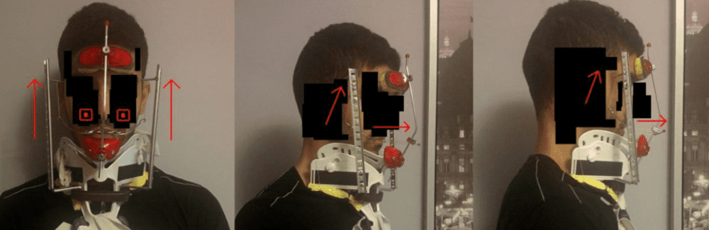 Facepulling headgear neckbrace 2