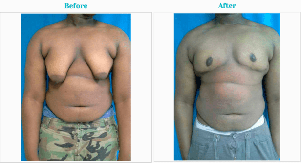 Gynecomastia Surgery Before and After