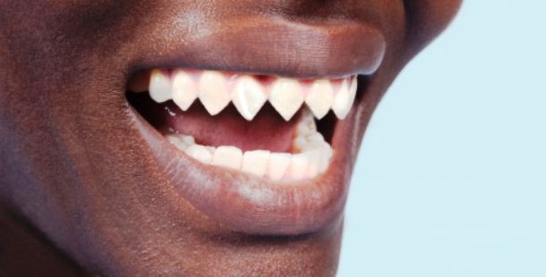 Need help finding dentist or a how to on sharpening teeth | Looksmax ...