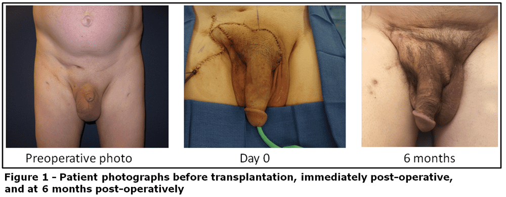 Penis transplant