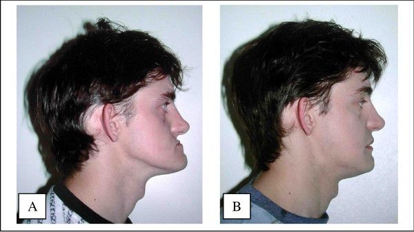 Advantages of the Lefort 1 procedure in case of jaw discrepancy It improves facial