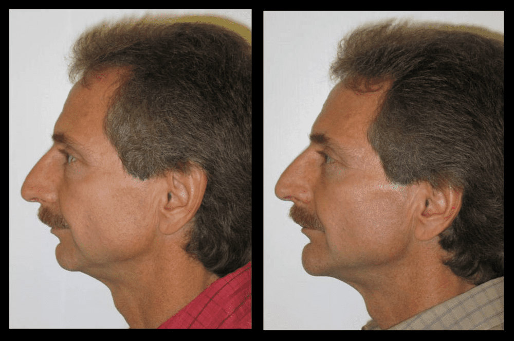 Which surgery is superior? CCW Jaw Rotation vs Sliding Genioplasty ...