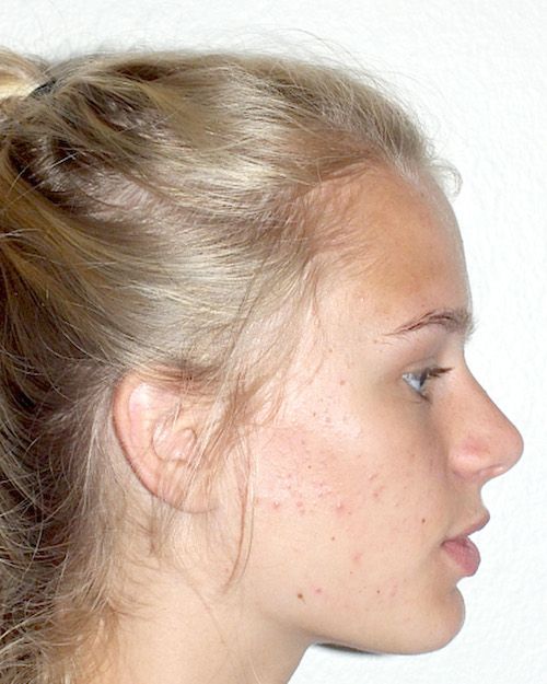 Lower jaw deficiency After
