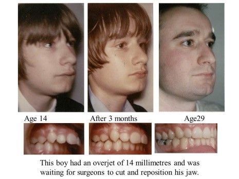 Jaw surgery