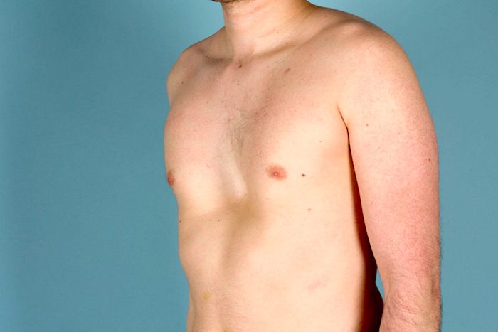Pectus Pectus