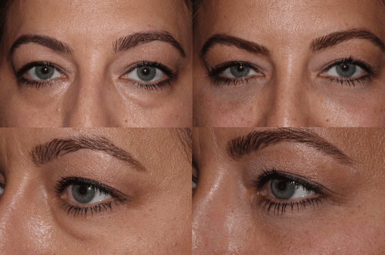 Under eye bag rejuvenation surgery Dr Guy Massry