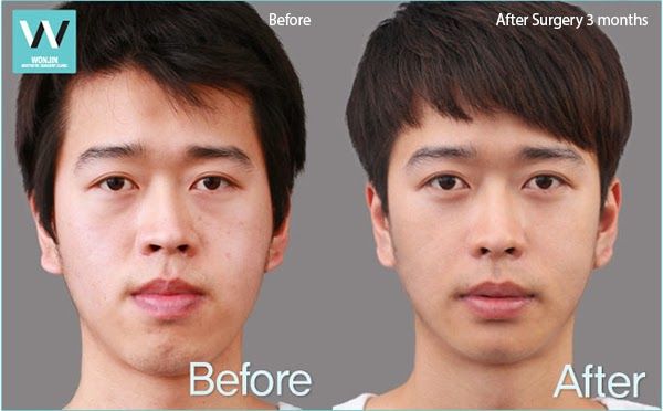Male protruding mouth before and after 01