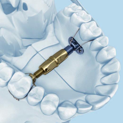 Maxilla Rotation Device How can I convince my parents to get get me surgery | Looksmax.org ...