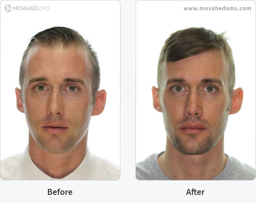 Obstructive sleep apnea osa surgery case study4 full front before after