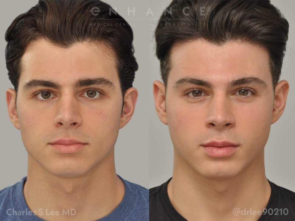 Jaw narrowing charles s lee 975x731