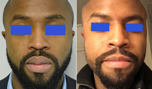 Hall Boston Lip Reduction 1 AP