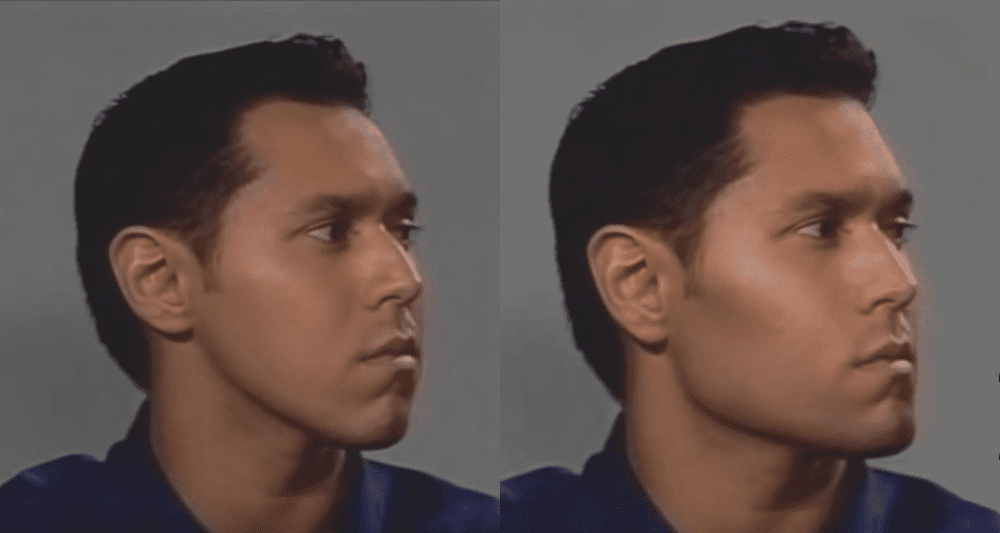 Sharp Ramus The ramus is the most important part of the mandible | Looksmax.org ...