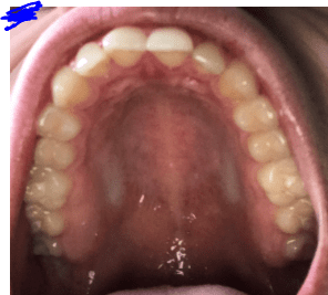 Palate