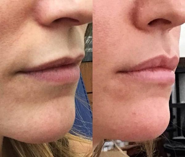 Botox lip flip 600x511