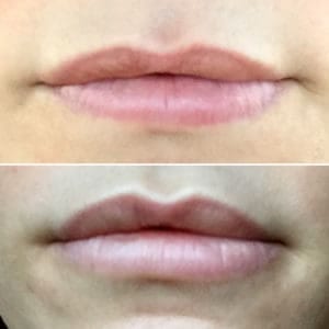 Botox lip flip 2 300x300