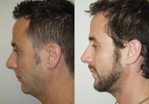 Case 12295 chin augmentation before after 1 Case 12295 chin augmentation before after 1