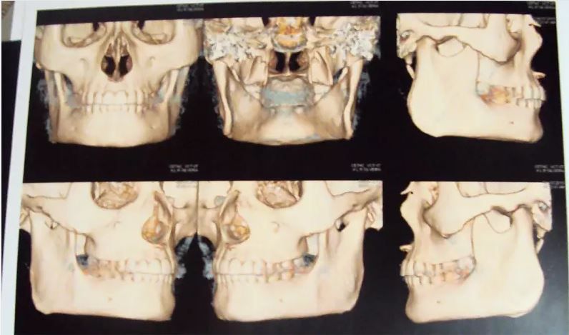Ctscans