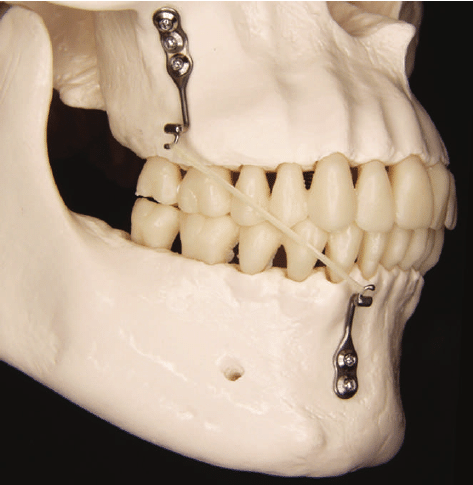 The-upper-miniplate-is-fixed-by-three-monocortical-screws-at-the-infrazygomatic-crest.png
