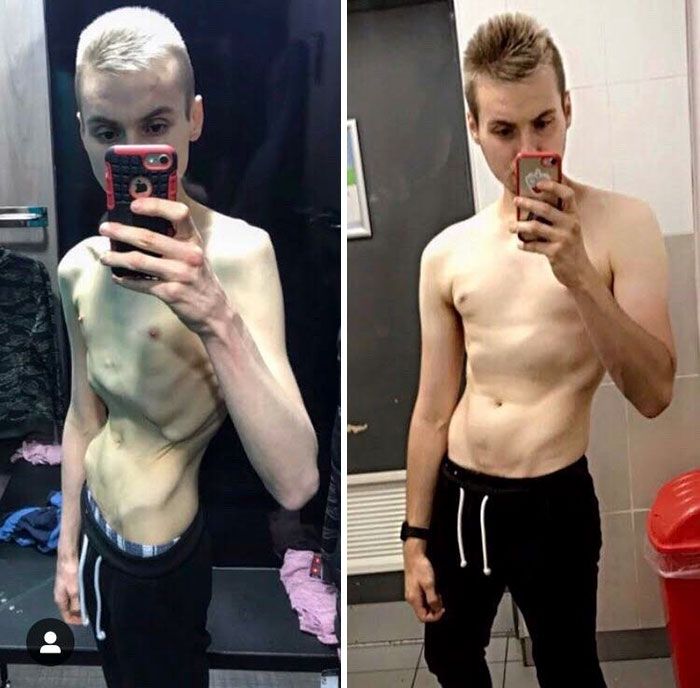 Male anorexia discussion 5dde413100b32  700