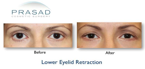 Lower eyelid retraction before and after screenshot cropped