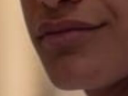 Chin philtrum