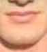 Chin philtrum 2