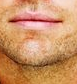 Chin philtrum 3
