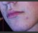 Chin philtrum 4