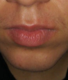Chin philtrum bad 2
