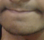 Chin philtrum bad 1