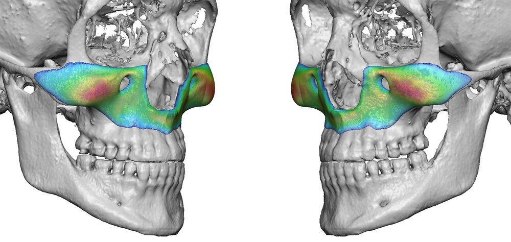 Total Custom Midface Implant Dr Barry Eppley Indianapolis