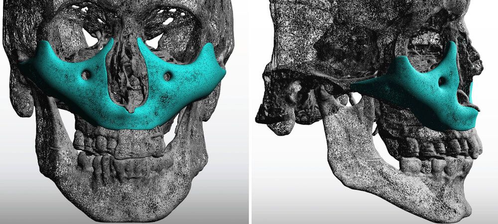 Total Midface Implant design Dr Barry Eppley Indianapolis