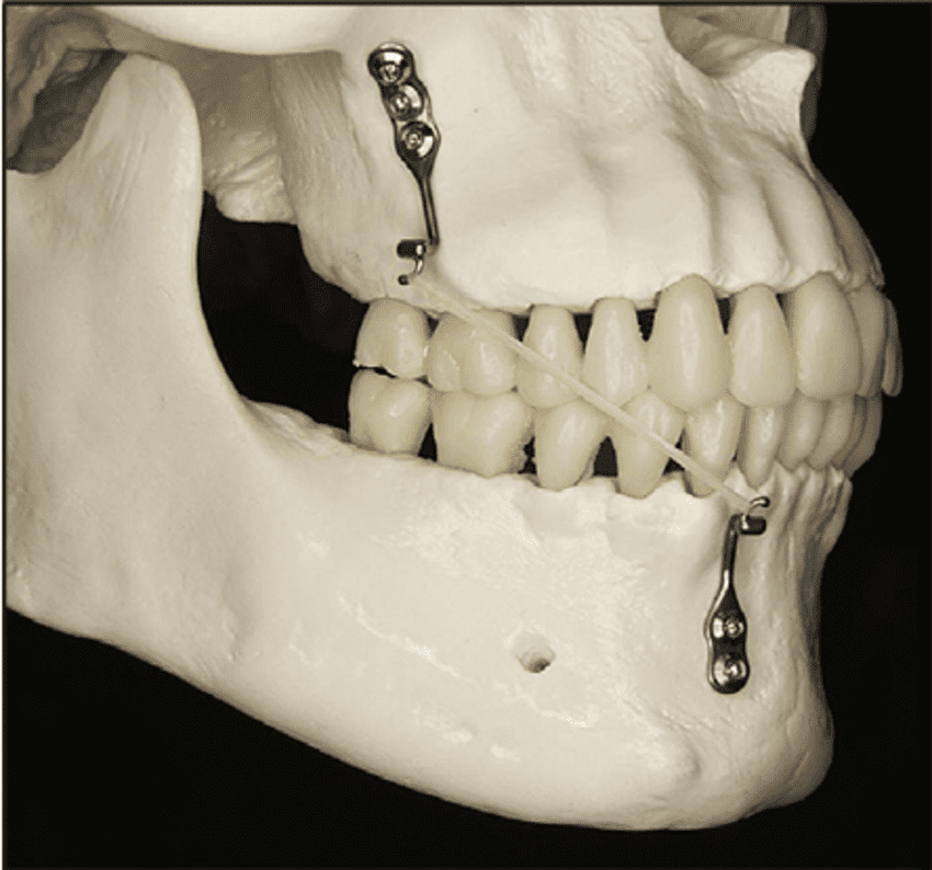 Skull illustrating the anatomic locations of the bone anchors