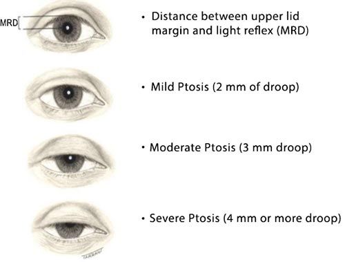 Droopy Eyelid Ptosis Treatment NYC