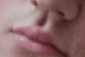 Philtrum mog
