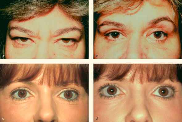 2710 93 201 orbicularis oculi muscle hypertrophy