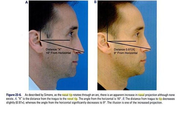 Diagram Simons tip analysis from ear