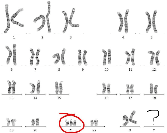 Trisomy21karyotype