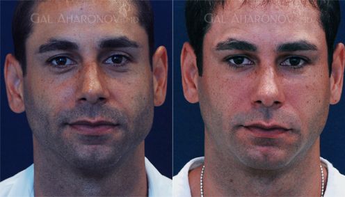 Facial filler men brow filler under eye filler 01
