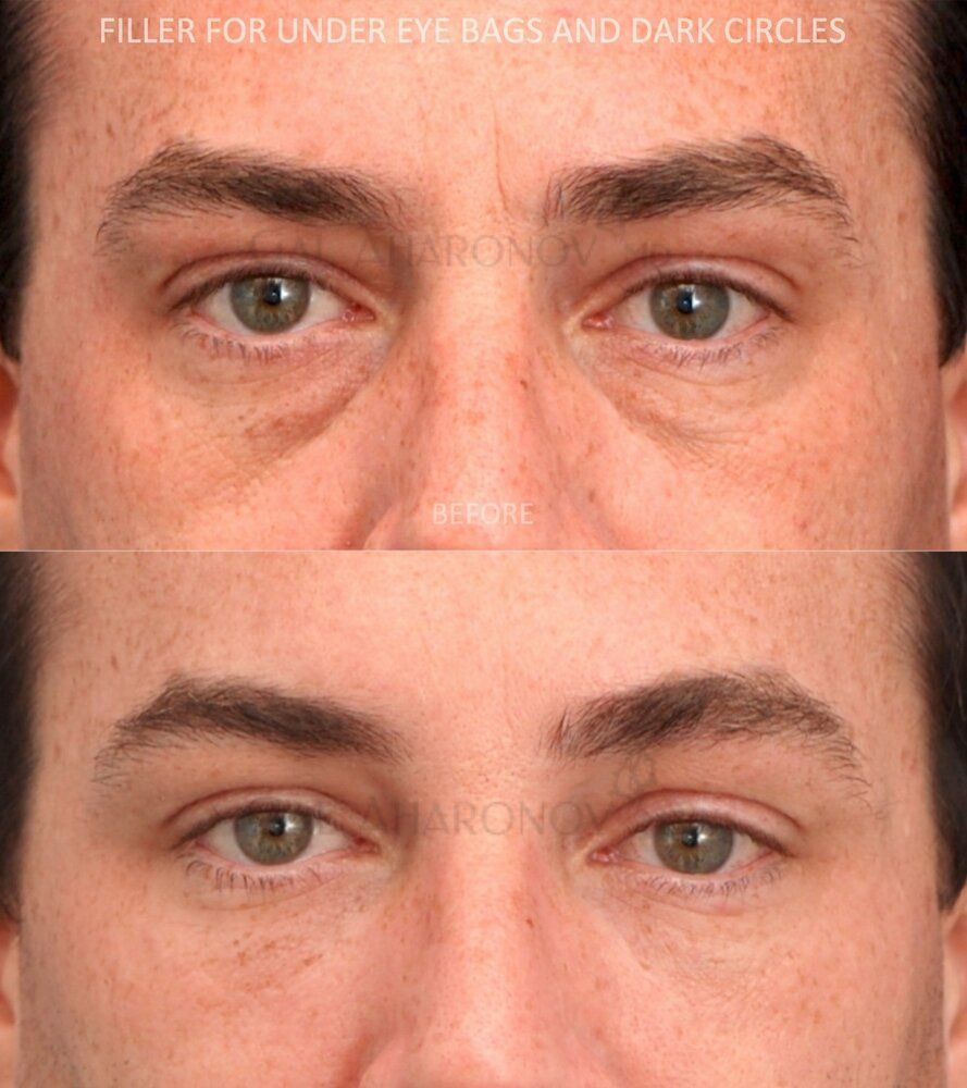 Under eye filler puffy eyelids concealer lower eyelids dark cirlces