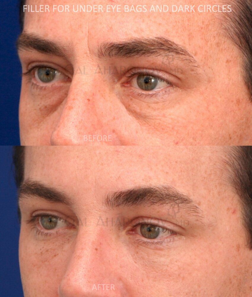 Under eye filler lower filler dark circles eyelid bags 01