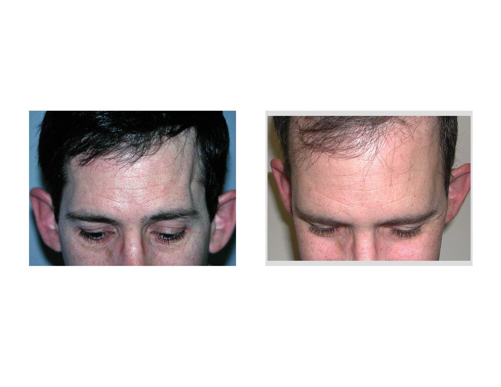 Temporal augmentation dr barry eppley indianapolis