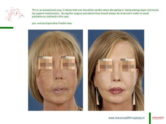 Deprojection of the nasal tip 13 638